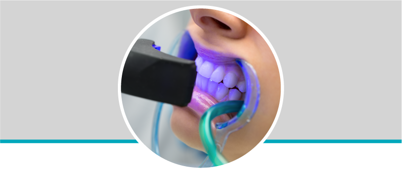 Valoración de blanqueamiento dental en Odontólogos La 73, Laureles, Medellín