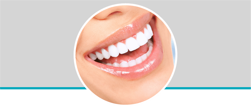 Diseño de sonrisa en resina