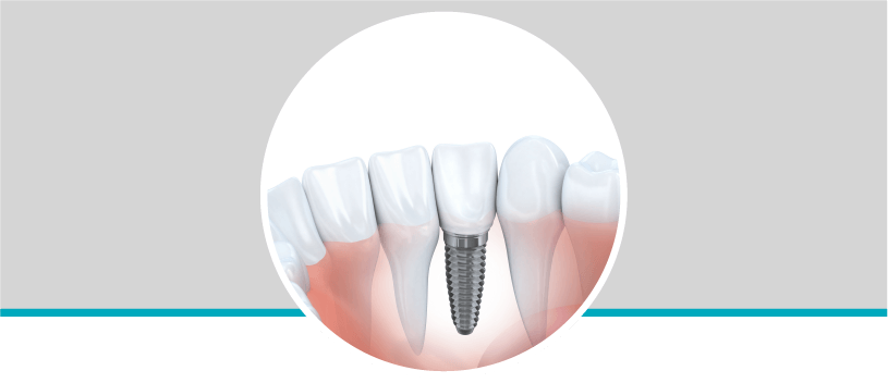 Implantes dentales