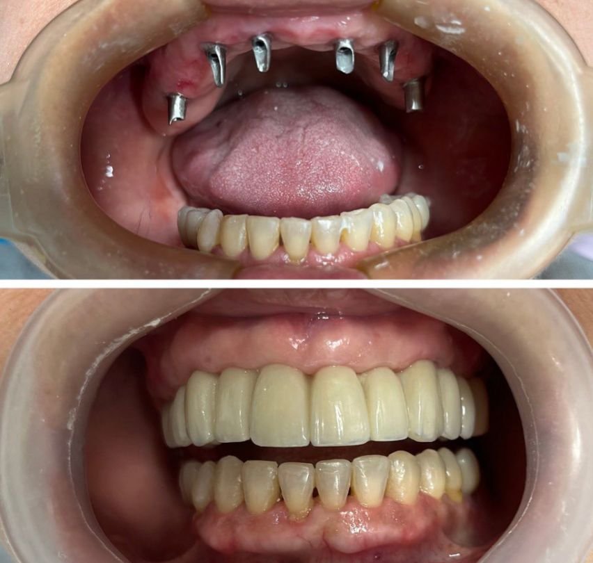 Maxilar superior con pilares de titanio sobre implantes y, debajo, la prótesis fija ya colocada en Odontólogos La 73, Medellín